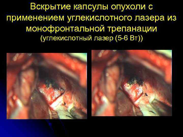  Вскрытие капсулы опухоли с применением углекислотного лазера из монофронтальной трепанации  (углекислотный лазер