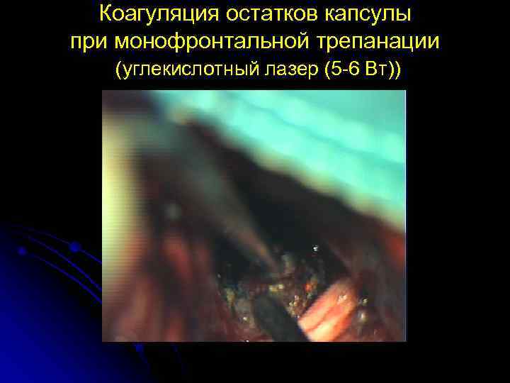  Коагуляция остатков капсулы при монофронтальной трепанации  (углекислотный лазер (5 -6 Вт)) 