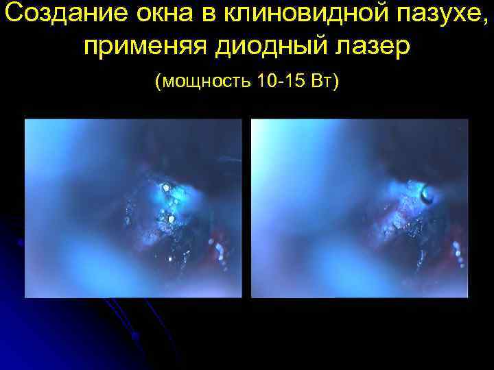 Создание окна в клиновидной пазухе,  применяя диодный лазер  (мощность 10 -15 Вт)