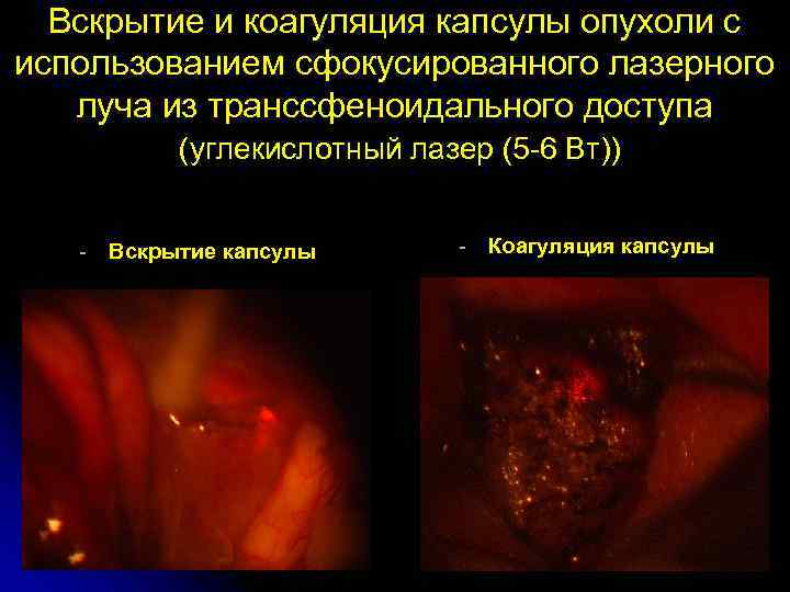  Вскрытие и коагуляция капсулы опухоли с использованием сфокусированного лазерного  луча из транссфеноидального