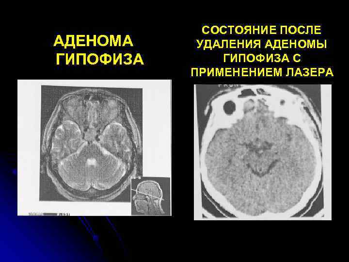    СОСТОЯНИЕ ПОСЛЕ АДЕНОМА УДАЛЕНИЯ АДЕНОМЫ ГИПОФИЗА С  ПРИМЕНЕНИЕМ ЛАЗЕРА 