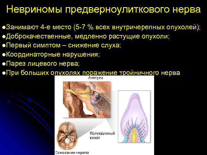  Невриномы предверноулиткового нерва l. Занимают 4 -е место (5 -7 % всех внутричерепных