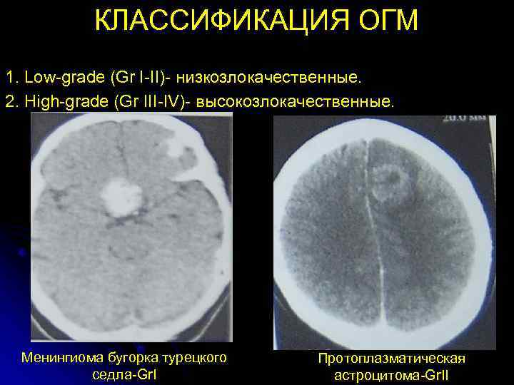   КЛАССИФИКАЦИЯ ОГМ 1. Low-grade (Gr I-II)- низкозлокачественные. 2. High-grade (Gr III-IV)- высокозлокачественные.