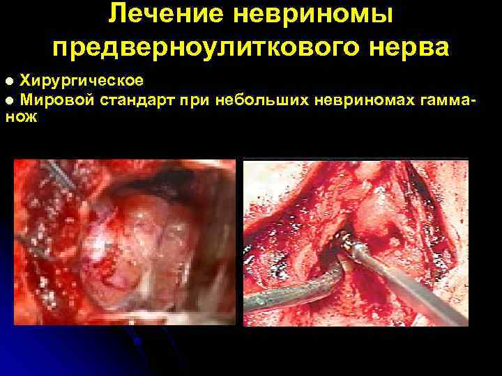   Лечение невриномы предверноулиткового нерва l Хирургическое l Мировой стандарт при небольших невриномах