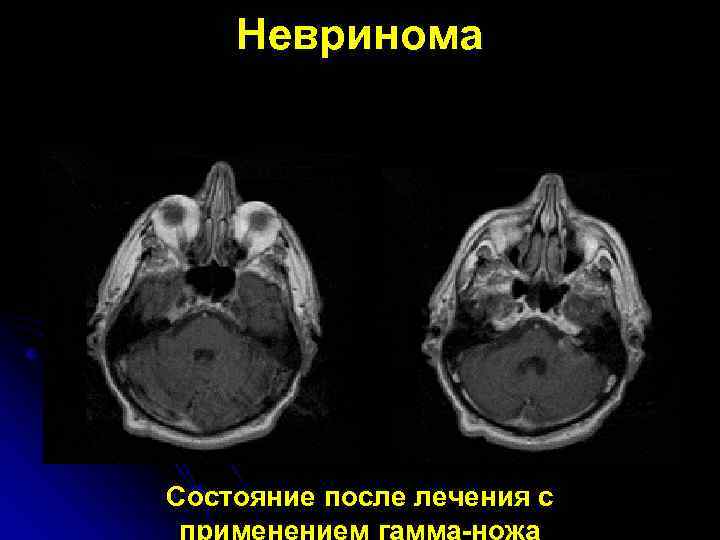   Невринома Состояние после лечения с применением гамма-ножа 