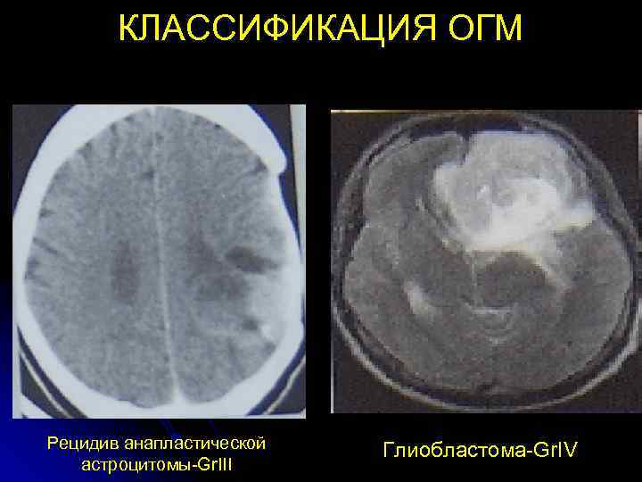   КЛАССИФИКАЦИЯ ОГМ Рецидив анапластической  Глиобластома-Gr. IV  астроцитомы-Gr. III 
