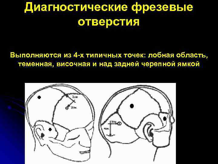 Диагностические фрезевые отверстия Выполняются из 4 -х типичных точек: лобная область, теменная, височная и