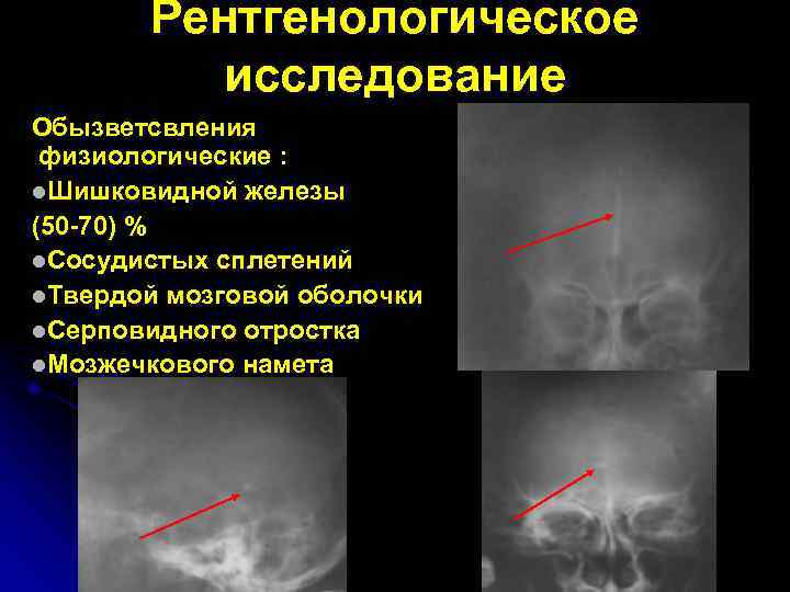 Рентгенологическое исследование Обызветсвления физиологические : l. Шишковидной железы (50 -70) % l. Сосудистых сплетений