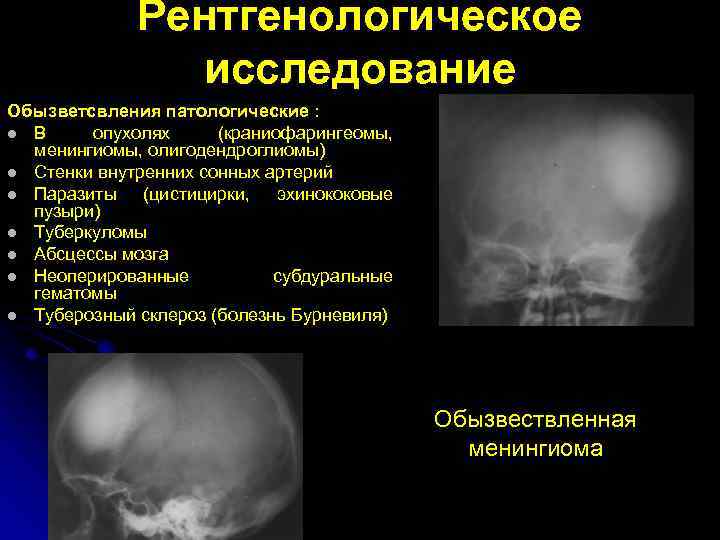 Рентгенологическое исследование Обызветсвления патологические : l В опухолях (краниофарингеомы, менингиомы, олигодендроглиомы) l Стенки внутренних