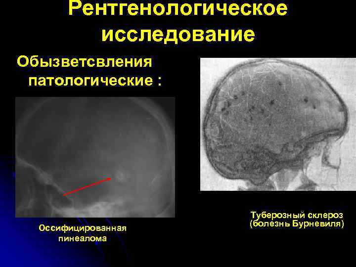 Рентгенологическое исследование Обызветсвления патологические : Оссифицированная пинеалома Туберозный склероз (болезнь Бурневиля) 