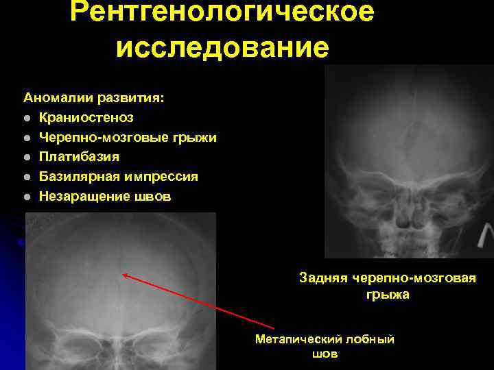 Рентгенологическое исследование Аномалии развития: l Краниостеноз l Черепно-мозговые грыжи l Платибазия l Базилярная импрессия