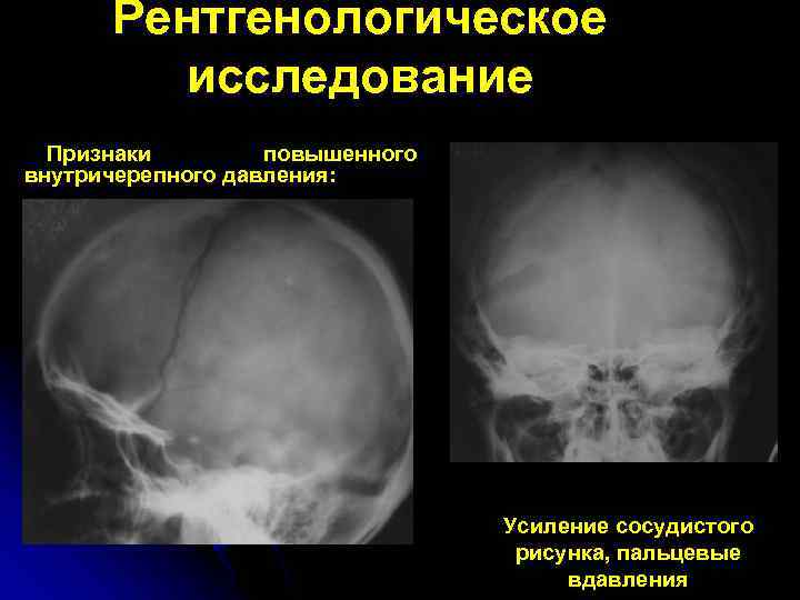 Усиление сосудистого рисунка черепа что значит