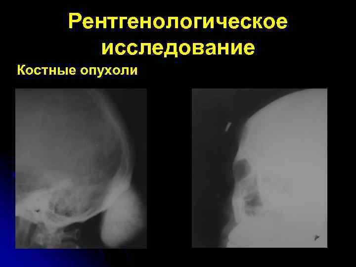 Рентгенологическая картина костного анкилоза внчс характеризуется