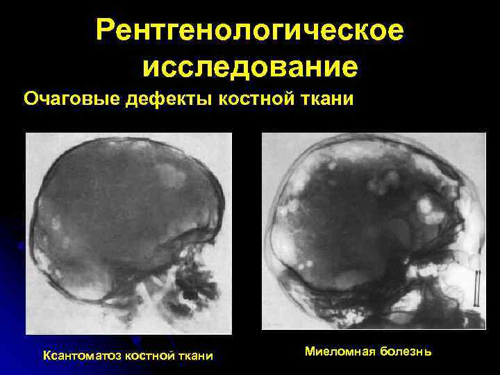 Рентгенологическое исследование Очаговые дефекты костной ткани Ксантоматоз костной ткани Миеломная болезнь 