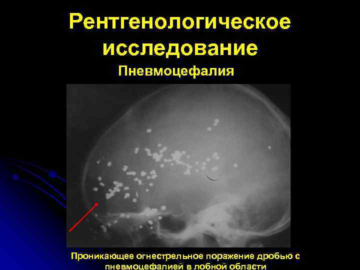Рентгенологическое исследование Пневмоцефалия Проникающее огнестрельное поражение дробью с пневмоцефалией в лобной области 