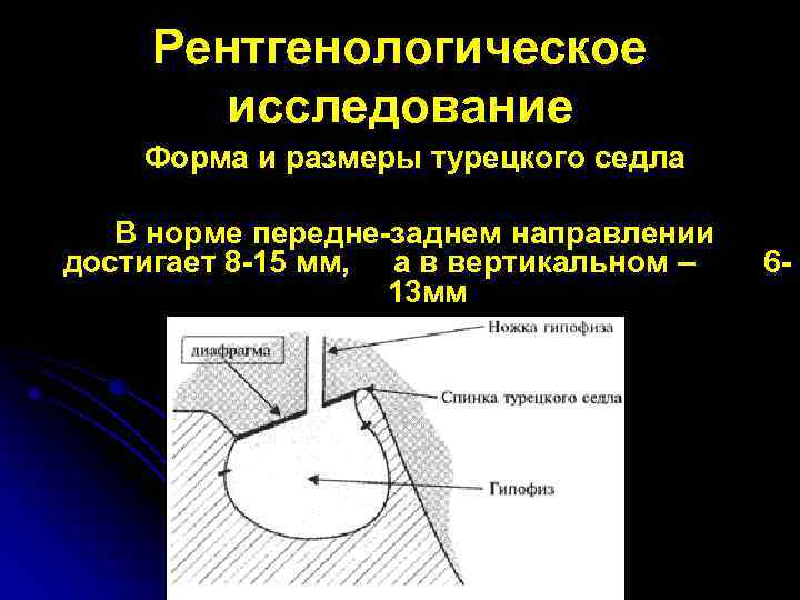 Рентгенологическое исследование Форма и размеры турецкого седла В норме передне-заднем направлении достигает 8 -15