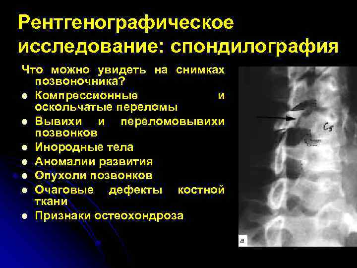 Рентгенографическое исследование: спондилография Что можно увидеть на снимках позвоночника? l Компрессионные и оскольчатые переломы