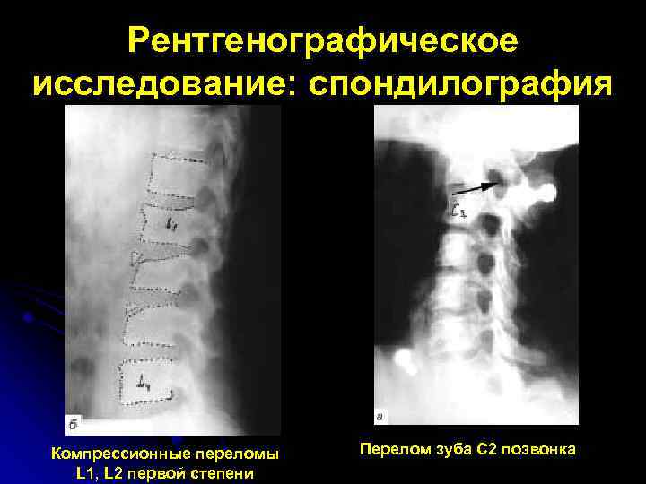 Рентгенографическое исследование: спондилография Компрессионные переломы L 1, L 2 первой степени Перелом зуба С