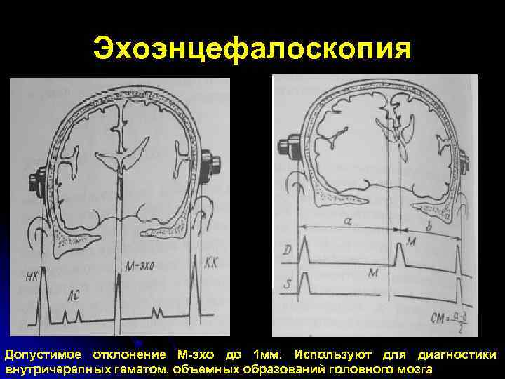 Эхоэнцефалоскопия Допустимое отклонение М-эхо до 1 мм. Используют для диагностики внутричерепных гематом, объемных образований