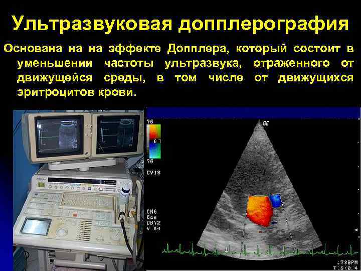 Ультразвуковая допплерография Основана на на эффекте Допплера, который состоит в уменьшении частоты ультразвука, отраженного