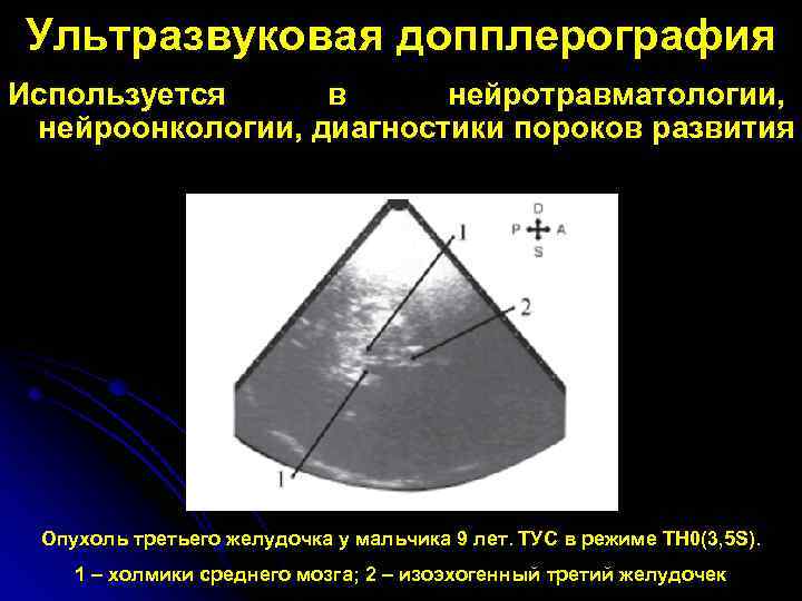 Ультразвуковая допплерография Используется в нейротравматологии, нейроонкологии, диагностики пороков развития Опухоль третьего желудочка у мальчика