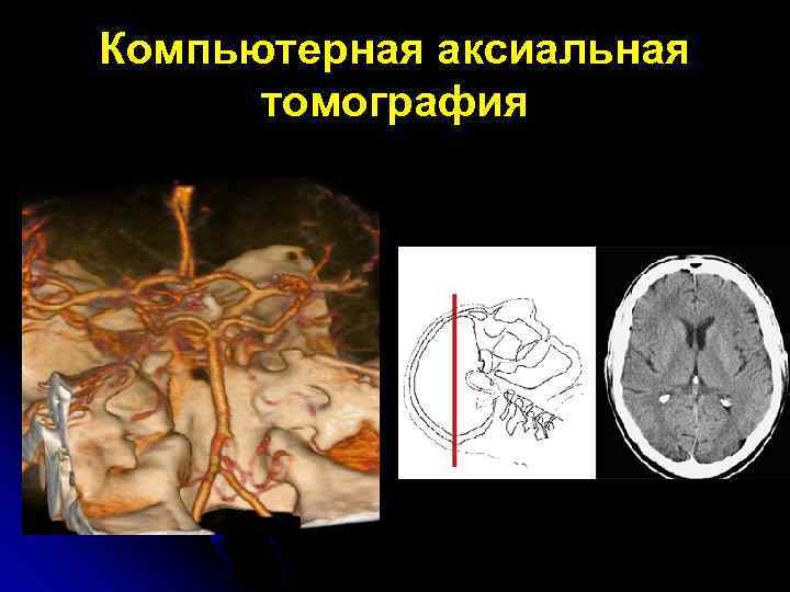 Компьютерная аксиальная томография 