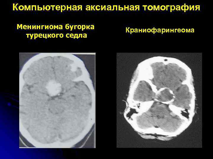 Компьютерная аксиальная томография Менингиома бугорка турецкого седла Краниофарингеома 