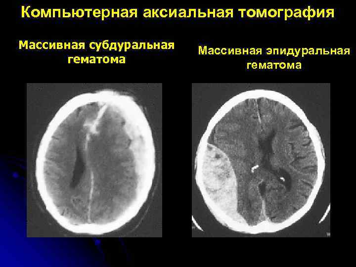 Компьютерная аксиальная томография Массивная субдуральная гематома Массивная эпидуральная гематома 