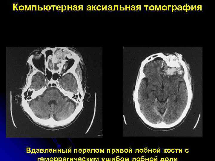 Компьютерная аксиальная томография Вдавленный перелом правой лобной кости с 