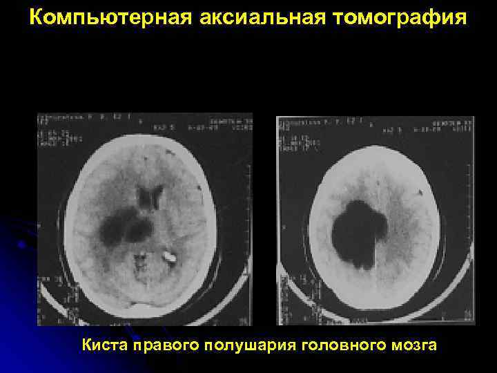 Компьютерная аксиальная томография Киста правого полушария головного мозга 