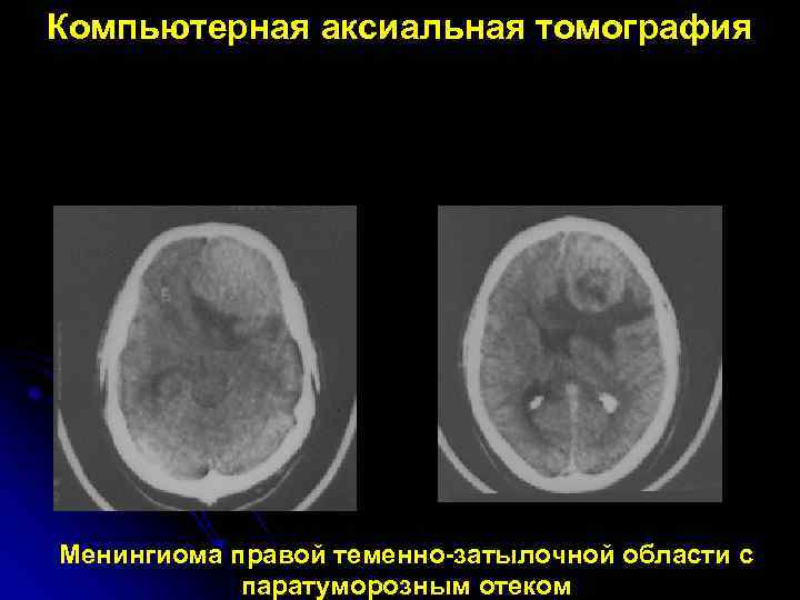 Компьютерная аксиальная томография Менингиома правой теменно-затылочной области с паратуморозным отеком 