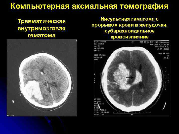 Компьютерная аксиальная томография Травматическая внутримозговая гематома Инсультная гематома с прорывом крови в желудочки, субарахноидальное