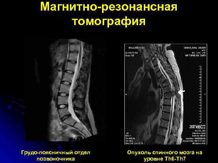 Магнитно-резонансная томография Грудо-поясничный отдел позвоночника Опухоль спинного мозга на уровне Th 6 -Th 7