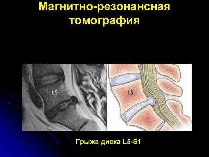 Магнитно-резонансная томография Грыжа диска L 5 -S 1 