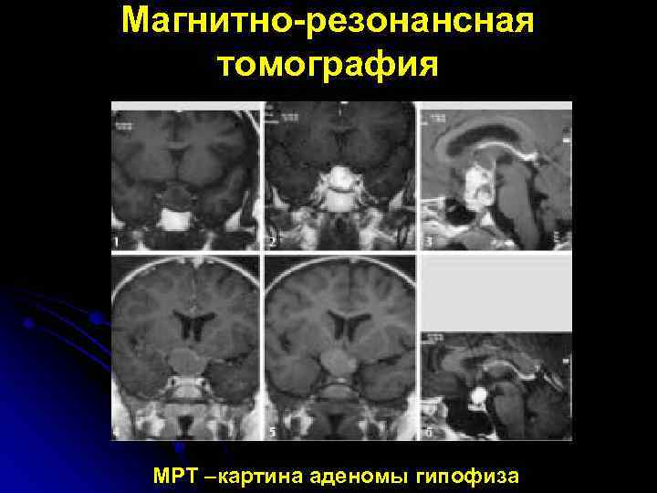 Магнитно-резонансная томография МРТ –картина аденомы гипофиза 