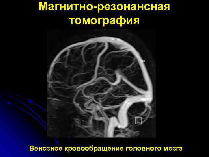 Магнитно-резонансная томография Венозное кровообращение головного мозга 