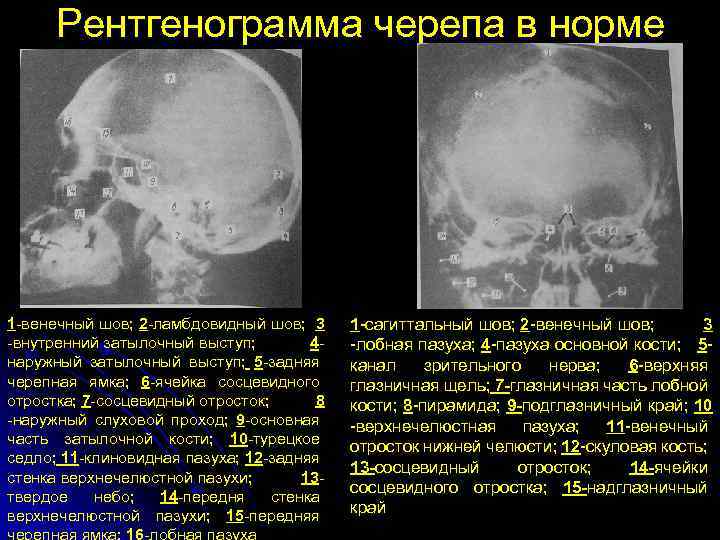 Рентгенограмма черепа в норме 1 -венечный шов; 2 -ламбдовидный шов; 3 -внутренний затылочный выступ;