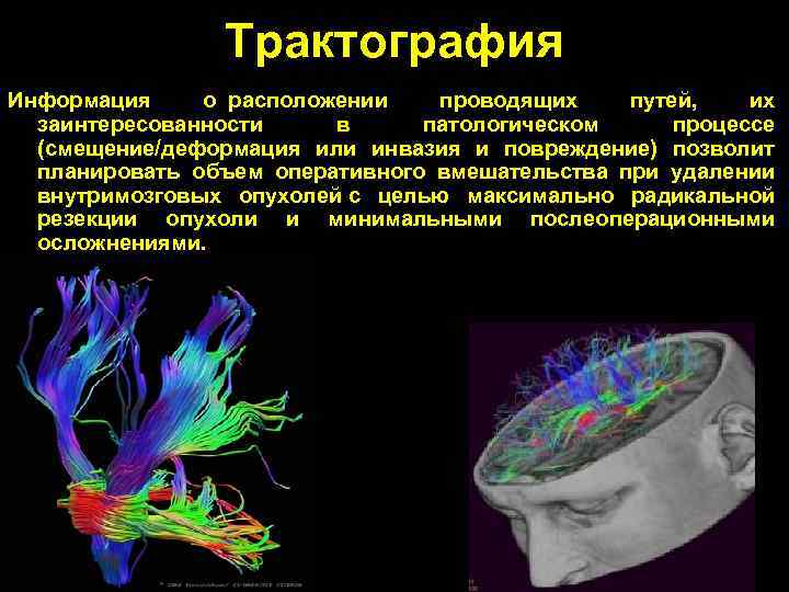 Диффузное пространство. Магнитно резонансная трактография. Трактография мрт. Трактография мозга. Диффузионная тензорная визуализация.