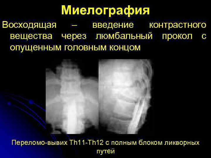 Миелография Восходящая – введение контрастного вещества через люмбальный прокол с опущенным головным концом Переломо-вывих