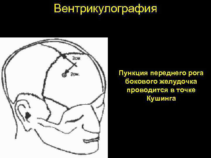 Вентрикулография Пункция переднего рога бокового желудочка проводится в точке Кушинга 