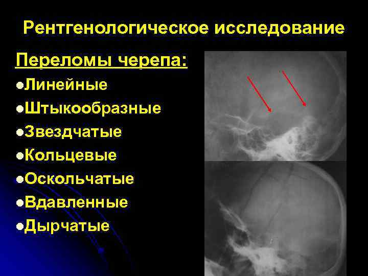 Рентгенологическое исследование Переломы черепа: l. Линейные l. Штыкообразные l. Звездчатые l. Кольцевые l. Оскольчатые