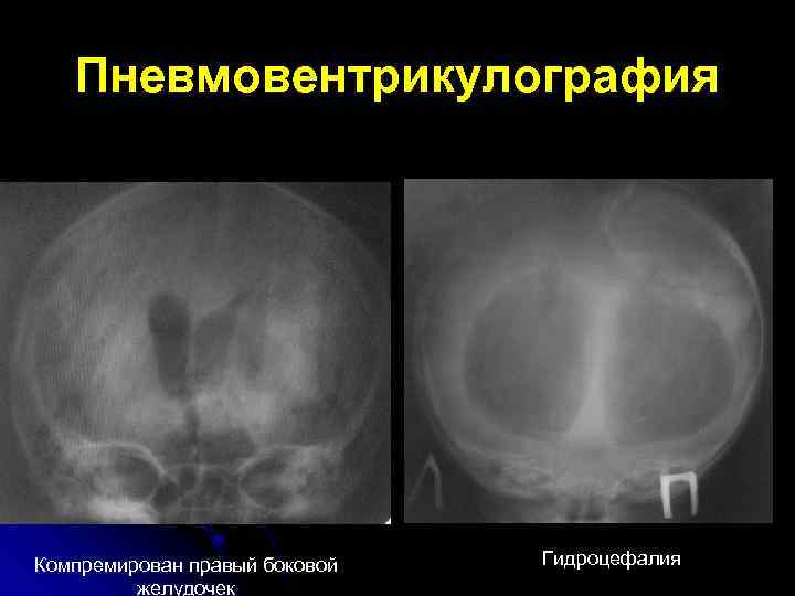 Пневмовентрикулография Компремирован правый боковой желудочек Гидроцефалия 