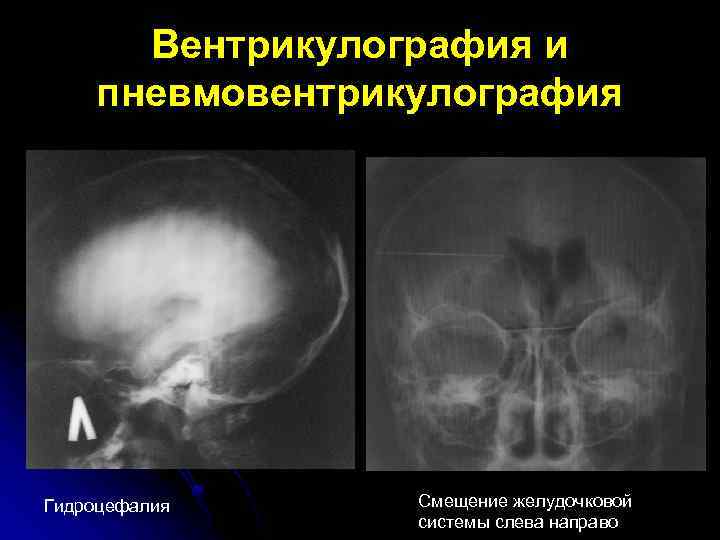 Вентрикулография и пневмовентрикулография Гидроцефалия Смещение желудочковой системы слева направо 