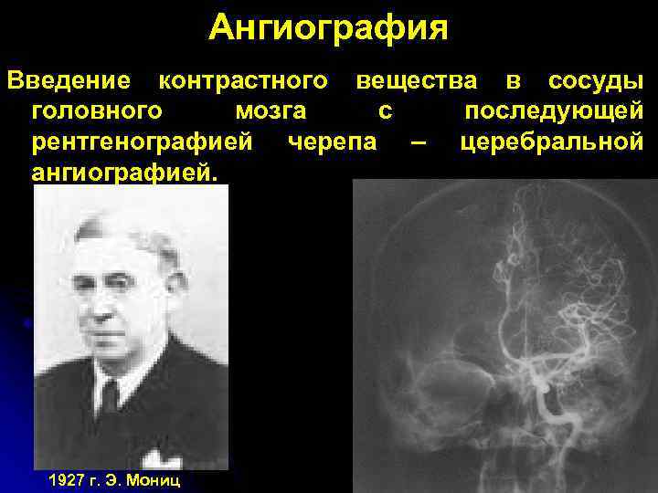 Ангиография Введение контрастного вещества в сосуды головного мозга с последующей рентгенографией черепа – церебральной