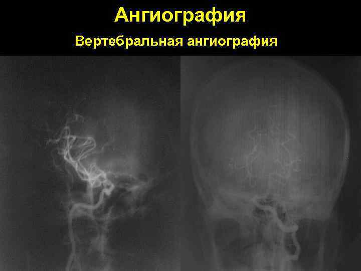 Ангиография Вертебральная ангиография 