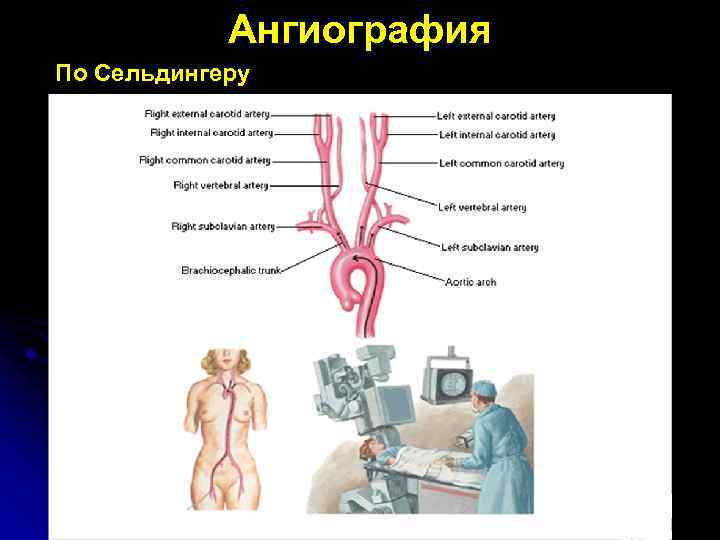 Ангиография По Сельдингеру 