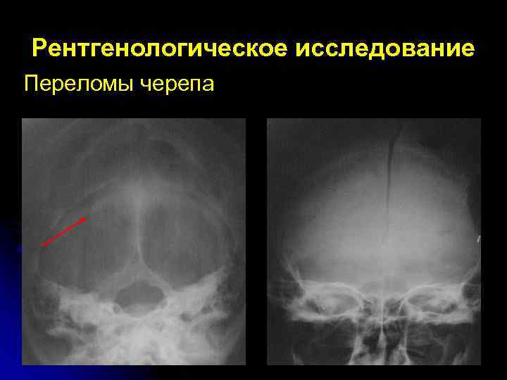 Рентгенологическое исследование Переломы черепа 