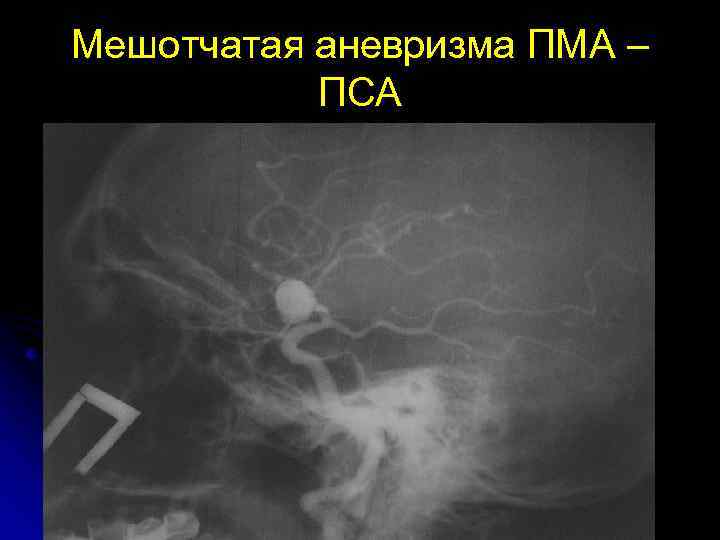 Мешотчатая аневризма ПМА – ПСА 