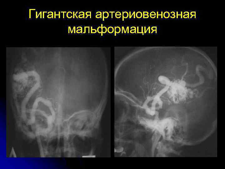 Гигантская артериовенозная мальформация 