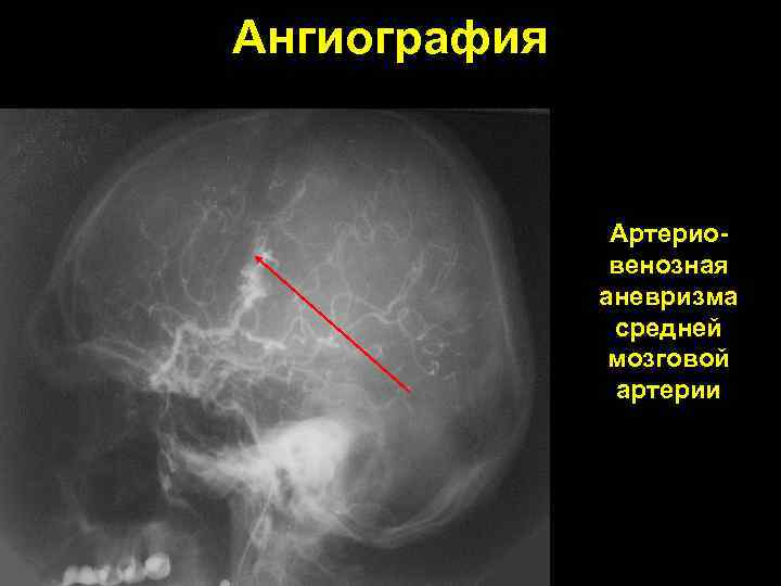 Ангиография Артериовенозная аневризма средней мозговой артерии 